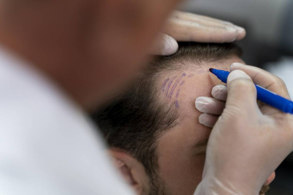 greffe cheveux aix les bains